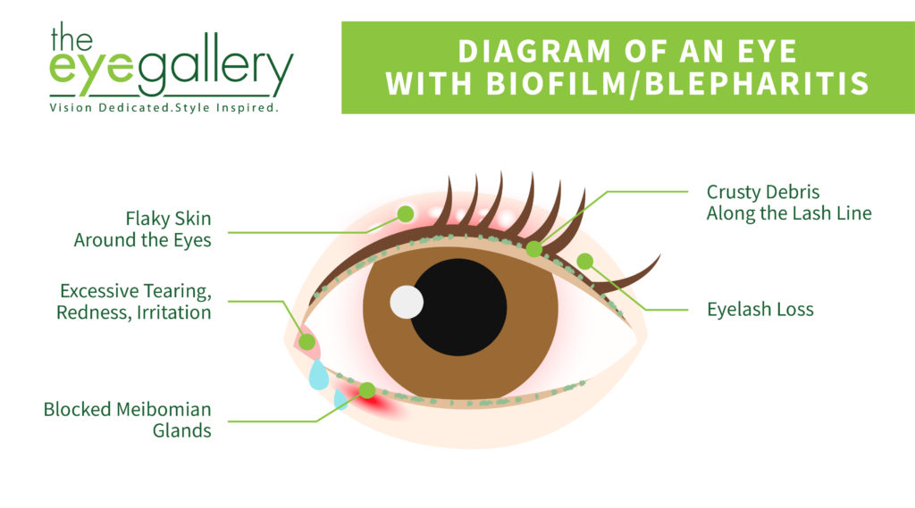 Biofilm Blepharitis Diagram