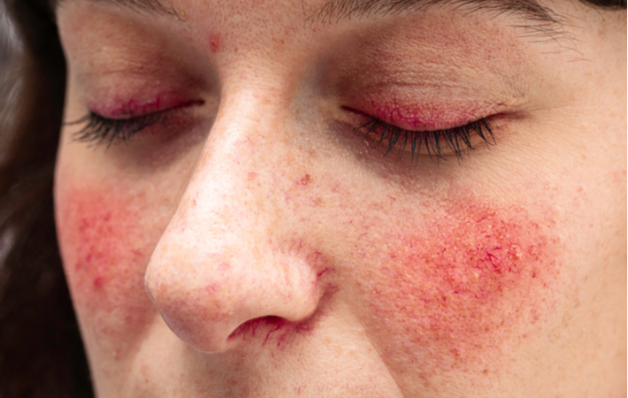 Red Eyelid Rosacea