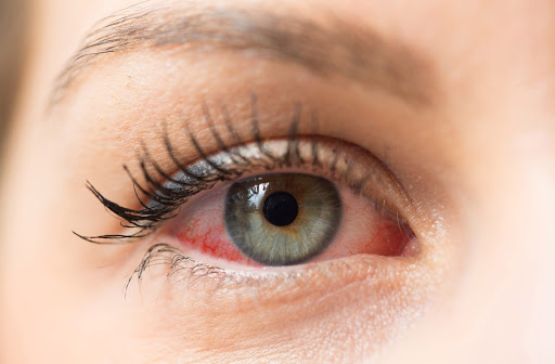 Dry eye symptoms can be similar, but causes can vary.