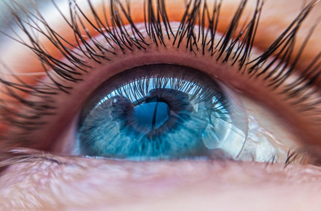 A scleral contact lens resting on a patient's eye