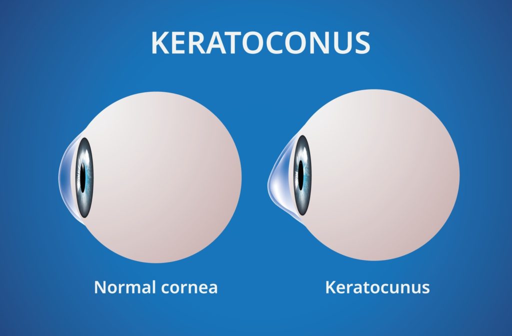 Illustration of normal cornea on the left and cornea with keratoconus on the right.