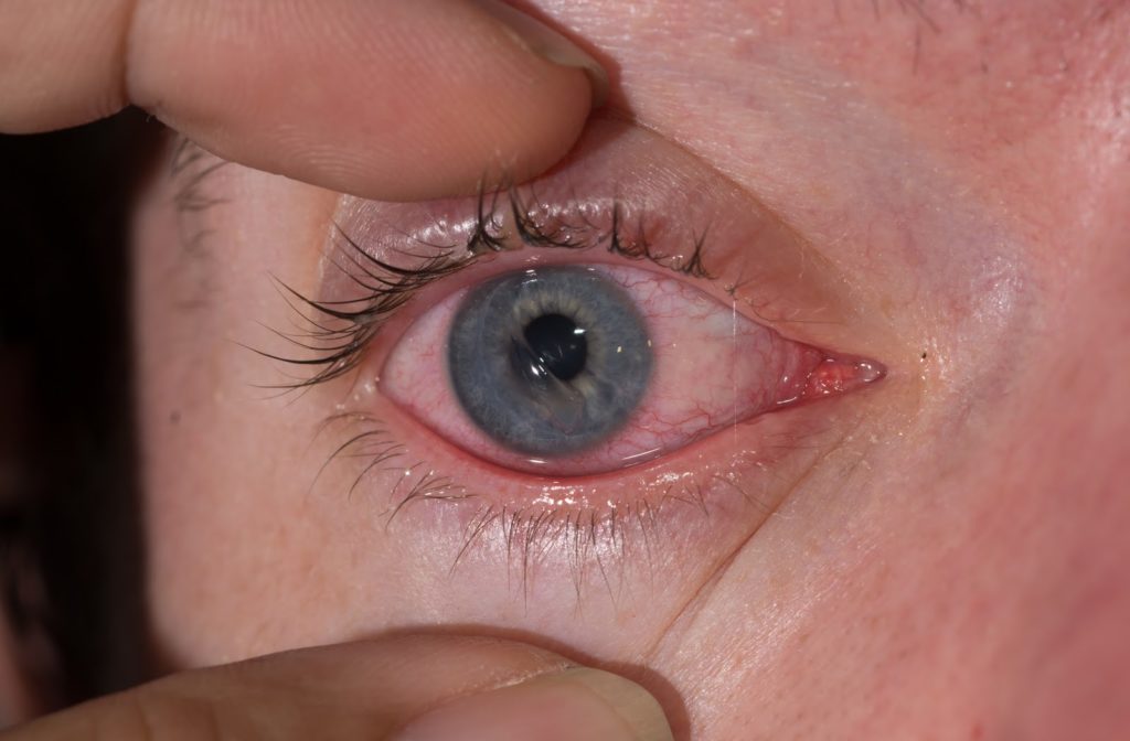 Close up of woman with blue eyes that has corneal scratch on eye.