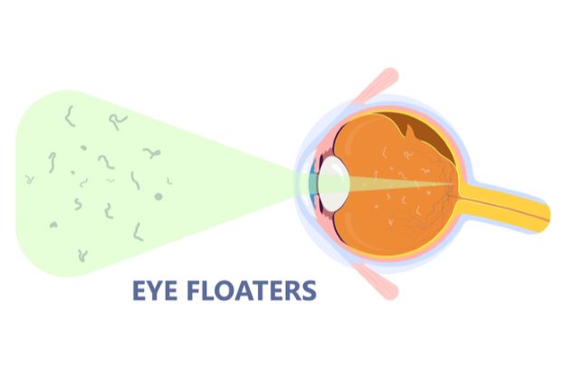 Illustration of eye floaters with floating material disturbing view