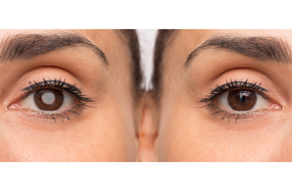 women with diabetic eye on left compared with normal eye on right